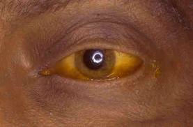 Got Hbv What Is Your Skin Trying To Tell You Hepatitis B Foundation Got Hbv What Is Your Skin Trying To Tell You Hepatitis B Foundation